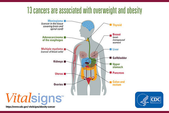 obesity-cancer