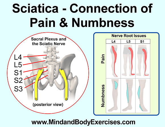 sciatica-pain & numbness