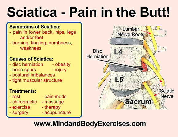 sciatica-causes & treatment graphic